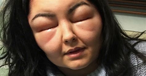 Teen Blinded By Horrific Frankenstein Allergic Reaction To Hair Dye