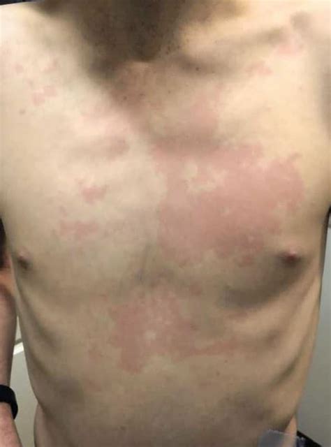 Skin Rash From Mold Exposure