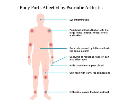 Psoriatic Arthritis Symptoms Causes Diagnosis And Treatment