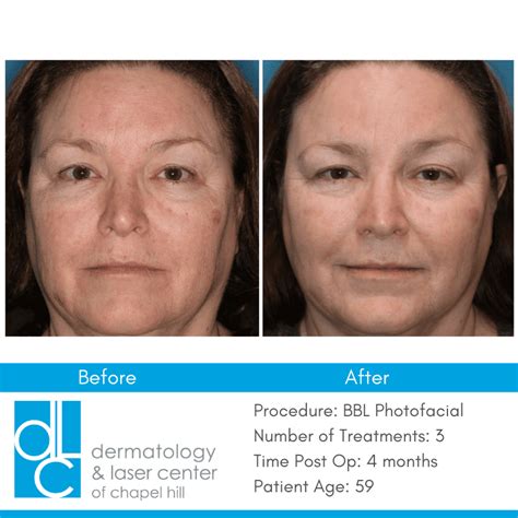 Bbl Face Treatment Before And After Your Magazine Lite