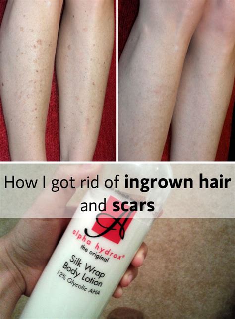 Ingrown hairs on the legs: Pin on Skin