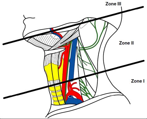 Division Of Clinical Anatomic Neck Zone I Begins 1 Cm Below The