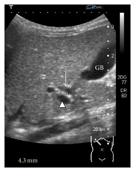 Common Bile Duct Dilatation On Ultrasound Arrow The Duct Is Measured