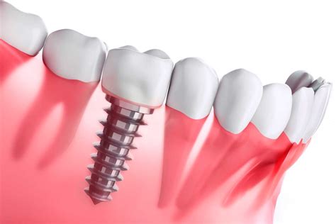 Implantes Dentales ¿cuál Necesitas Álvaro Y Franco Clínica Dental
