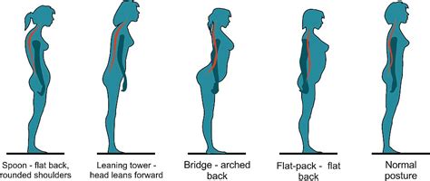 The British Chiropractic Association Says Posture Determines Whether You Ll Get Back Pain