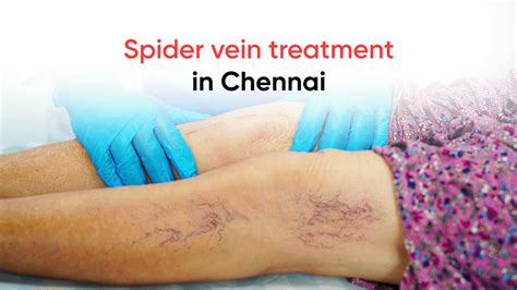 Spider Vein Treatment In Chennai Laser Vein Clinic