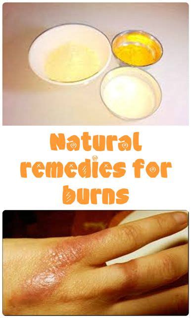 How To Treat Your Burns Burn Remedy Natural Remedies For Burns Skin