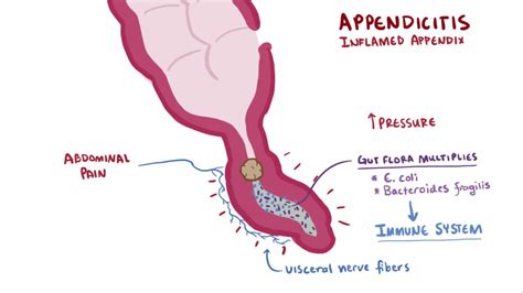 Appendicitis Wikipedia