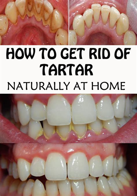 Once the dentist has removed tartar and plaque, he will advise you about various ways that you can maintain healthy teeth at home. How to Get Rid of Tooth Tartar Naturally at Home ...