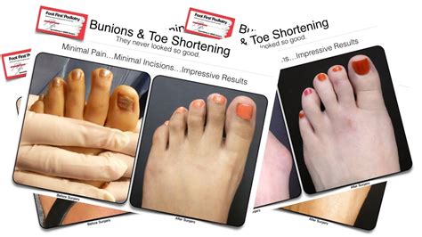 Toe Shortening The Before And After Results Youtube