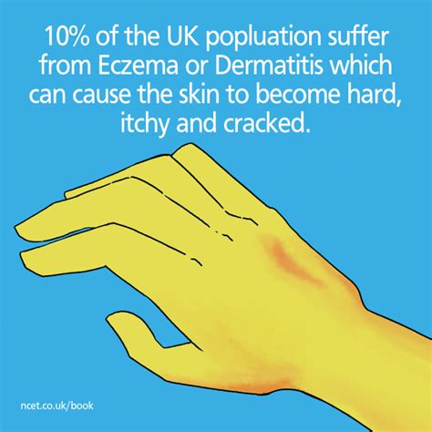 Eczema And Dermatitis Causes And Treatments National Centre For