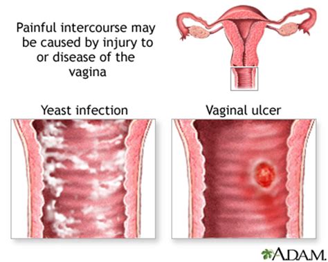 Causes Of Painful Intercourse Medlineplus Medical Encyclopedia Image
