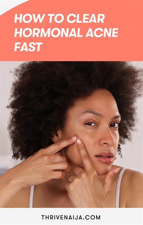 How To Clear Hormonal Acne Fast Complete Guide Thrivenaija