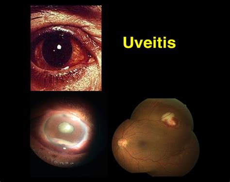 Uveítisinflamación De La Uvea Somos Retina Y Mácula Consultores