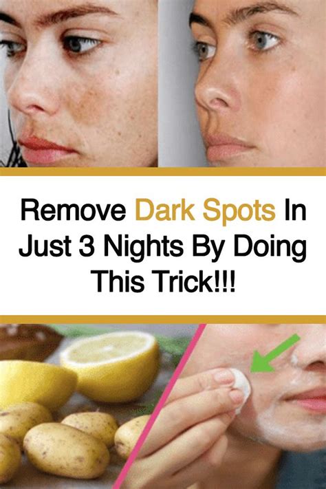 The Way To Get Rid Of Brown Spots On Experience The Natural Way