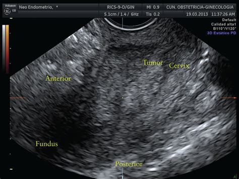 Transvaginaltransrectal Ultrasound For Preoperative Identification Of