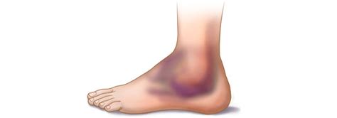 Ankle Sprains Symptoms Causes And Treatment Orthofootmd