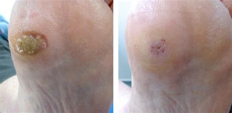 Laser Verruca Removal In Leeds And Bradford Skin Surgery Clinic