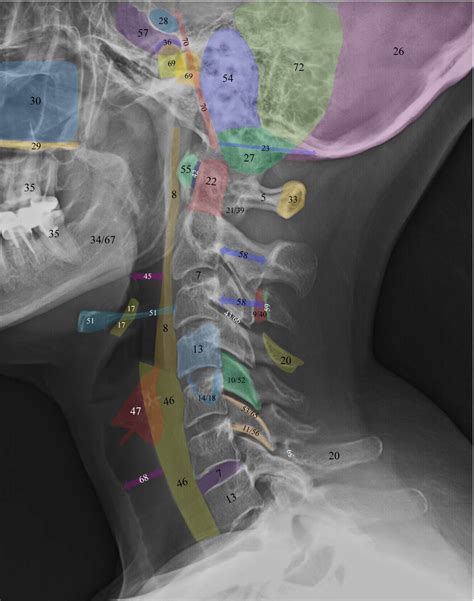 Normal Radiographic Anatomy Of The Cervical Spine Radiology Student