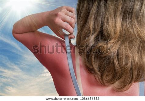Sunburn Concept Young Woman Red Sunburned Stock Photo Edit Now 1086656852
