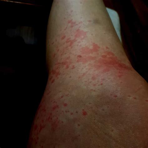 Hives Rash On Legs