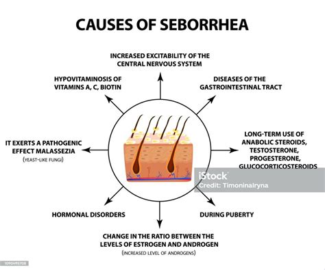 Causes Of Seborrhea Seborrhea Skin And Hair Dandruff Seborrheic