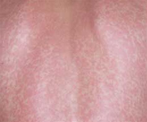 Stress Rash Pictures Causes Treatment Symptoms