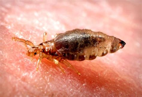 Bed Bugs Mites And Lice Human Skin Infestions Treatment
