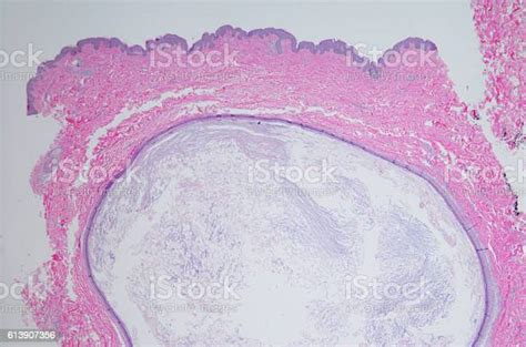 Epidermal Inclusion Cyst Also Known As Sebaceous Cyst Stock Photo