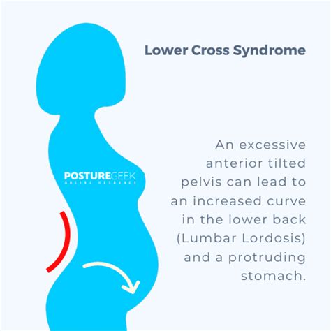 Janda Upper And Lower Cross Syndromes