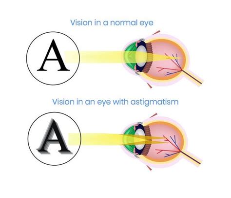 Astigmatism Focal Pointe Eye Care