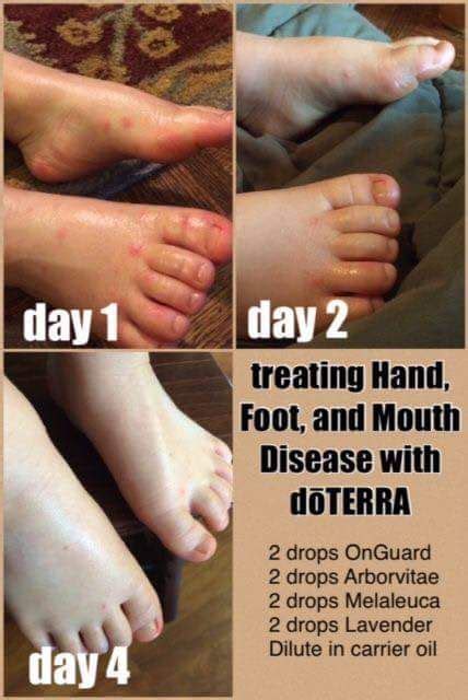 14 Best Hand Foot Mouth Disease Images On Pinterest Hand Foot And