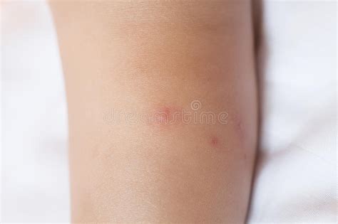 Children Mosquito Bites On The Legs Stock Image Image Of Sick Sting