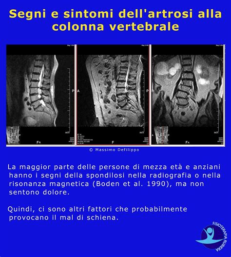 Artrosi Alla Colonna Vertebrale Dorsale Cervicale E Lombare Cause E Cure