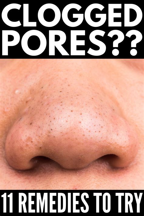 How To Get Rid Of Clogged Pores 11 Remedies And Products We Swear By In