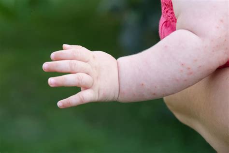 See more of cara hilangkan bintik hitam di muka on facebook. Penyebab dan Cara Mengatasi Bintik Merah Pada Kulit Bayi ...