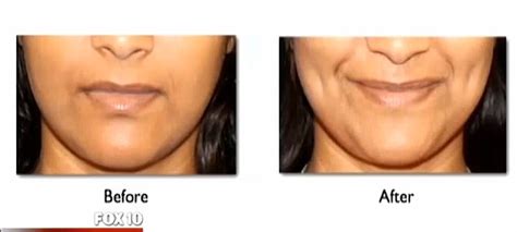 Women Are Having Dimple Surgery To Accentuate Their Grins Daily Mail