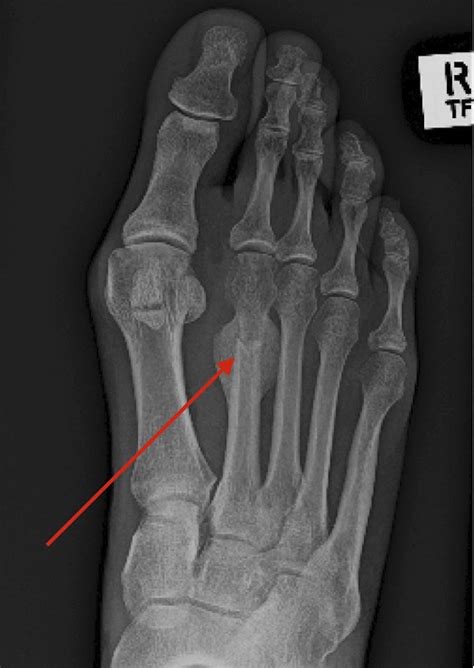 Cureus Surgical Realignment Of A Dorsiflexed Metatarsal Fracture