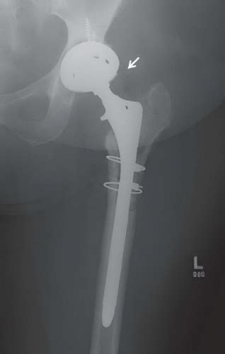Infected Hip Prosthesis Radiology Key