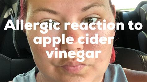 Allergic Reaction To Apple Cider Vinegar Youtube