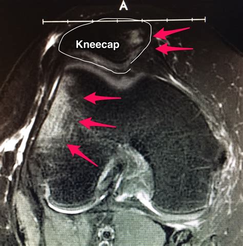 Anatomy Of The Knee Cap