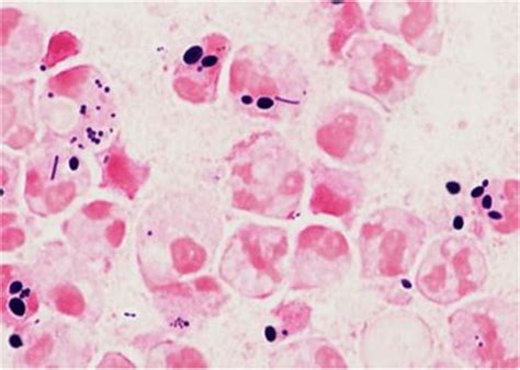 Sputum Gram Stain Case 4 At 1000x Magnification Showing Many Wbc