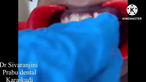 Laser Operculectomy Done Under Laser Prabu Dental Karaikudi