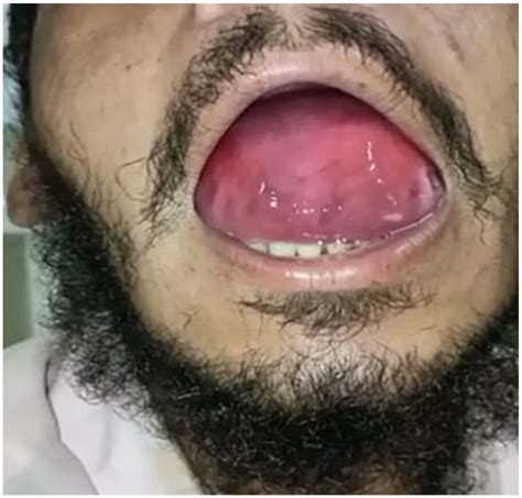 Sublingual Epidermoid Cyst Diagnosis Surgical Treatment And Follow