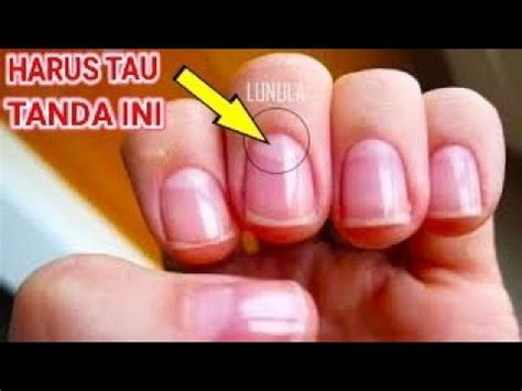Menurutnya jika tubuh kekurangan zinc bisa membuat seseorang pusing atau kelelahan. Kuku Tangan Hitam Sakit Apa | 06 Kuku