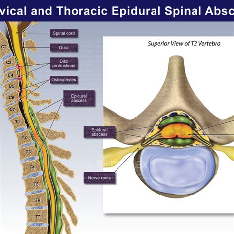 Cervical And Thoracic Epidural Spinal Abscess Trialexhibits Inc