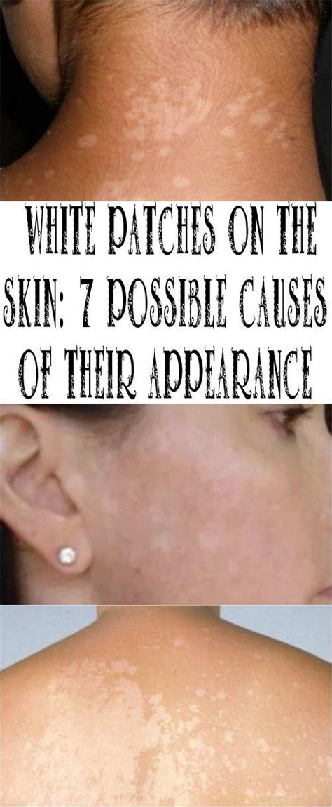 White Patches On The Skin 7 Possible Causes Of Their Appearance