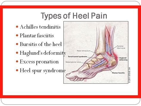 Pain In Heel Of Foot How To Get Rid Of Plantar Fasciitis Achilles