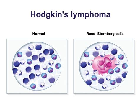 Hodgkin Lymphoma Hodgkin Disease Signs Diagnosis And Treatment In