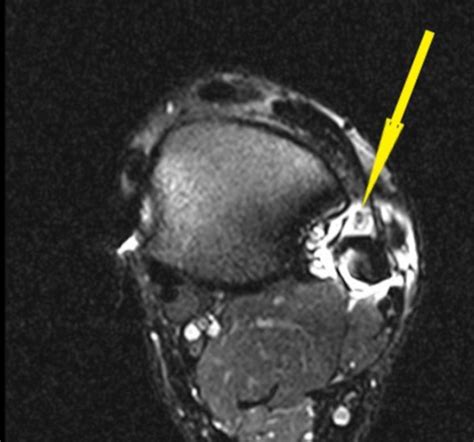 Superficial Peroneal Nerve Neuroma After Syndesmotic Stabilisation